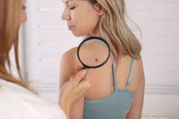What Are Traditional Skin Lesion Removal Methods Camberley?