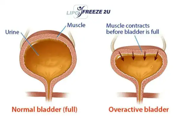 diagram of overactive bladder treatment Camberley