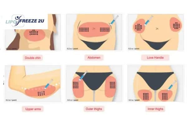 Benefits of Choosing Aqualyx for Fat Reduction Camberley