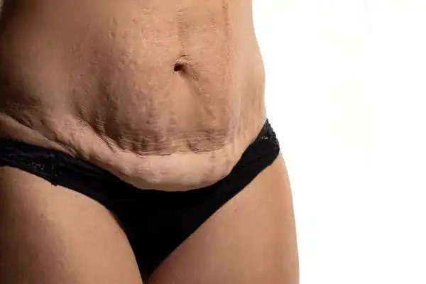 loose skin after weight loss injections Camberley