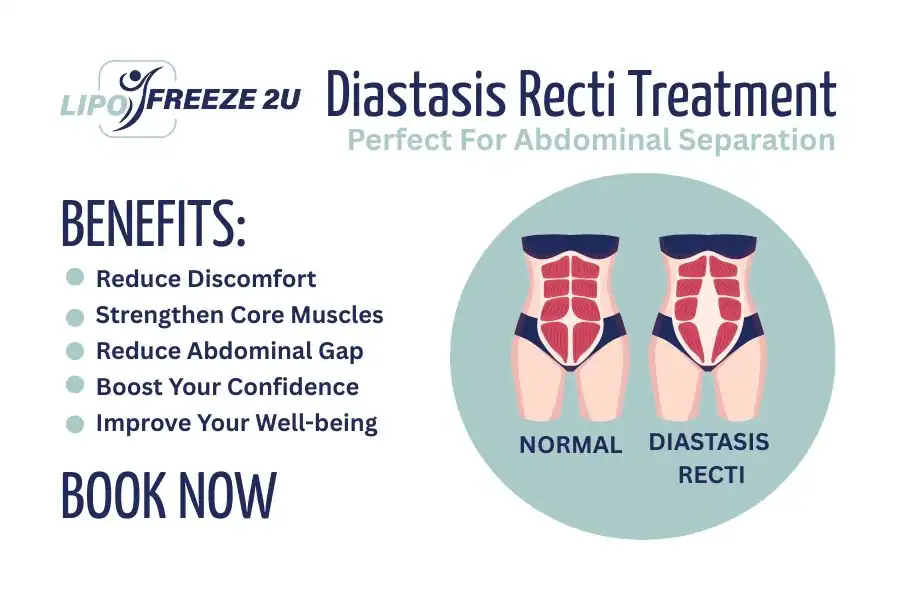 Benefits of body toning treatment Camberley for Diastasis recti