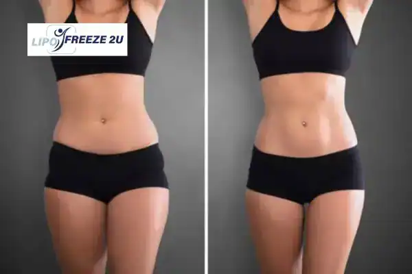 How Can LIPO FREEZE 2U Support Your Post-Pregnancy Body Recovery Camberley?