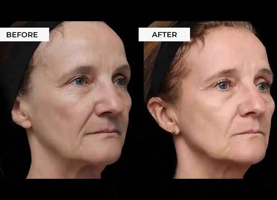 How Many RF Microneedling Sessions Will You Need to See a Difference Camberley?
