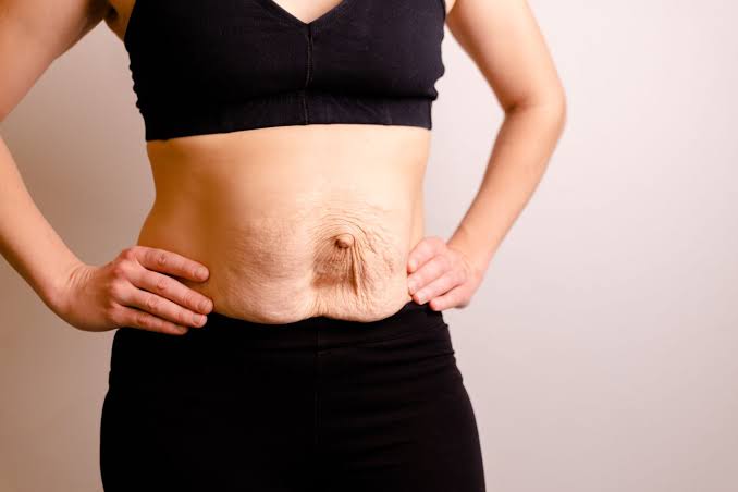Is Surgery Really the Only Way to Repair Diastasis Recti Camberley?