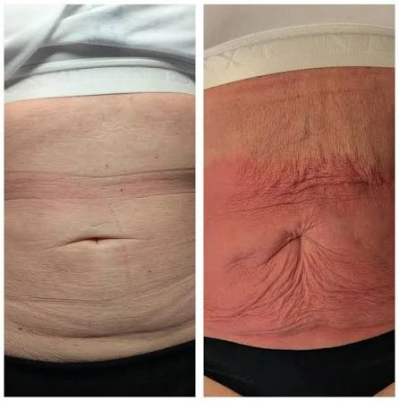 How Does RF Microneedling Improve Crepey, Thin and Uneven Skin Texture Camberley?