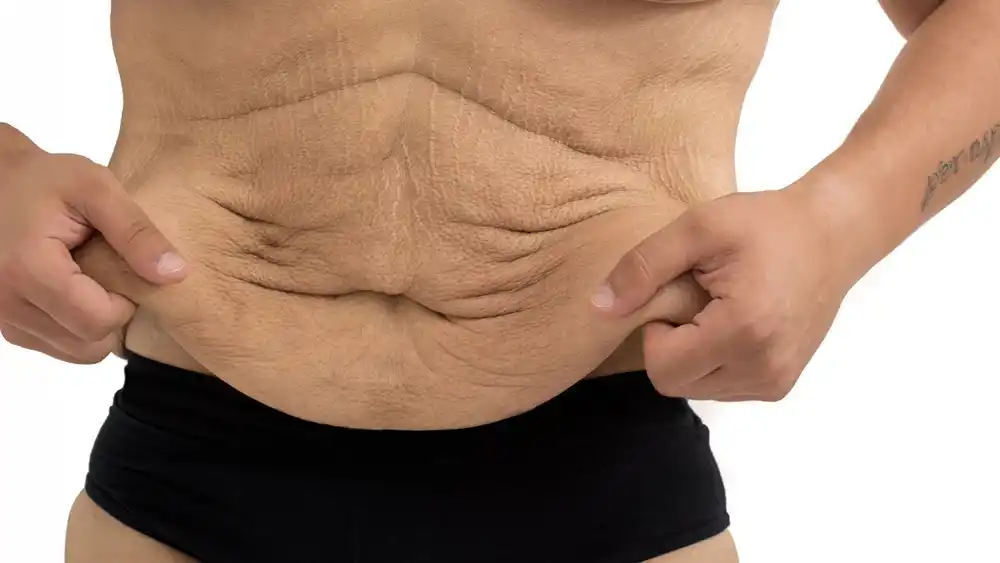 RF Microneedling for Loose Skin: How Can It Help Tighten and Reshape the Skin Camberley?
